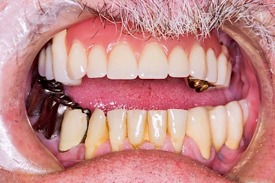 Beispiele: Lippen-Kiefer-Gaumenspalte