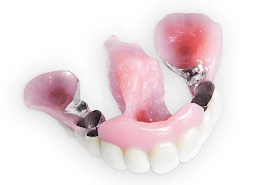 Beispiele: Lippen-Kiefer-Gaumenspalte