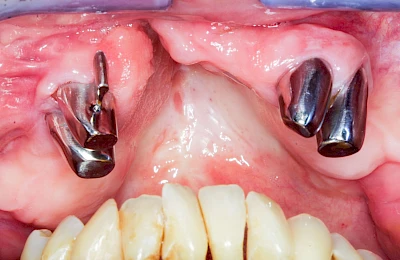Beispiele: Lippen-Kiefer-Gaumenspalte