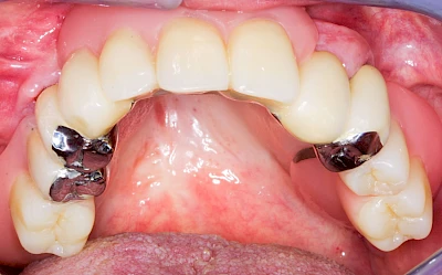Beispiele: Lippen-Kiefer-Gaumenspalte