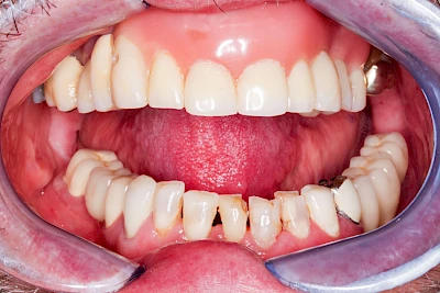 Beispiele: Lippen-Kiefer-Gaumenspalte