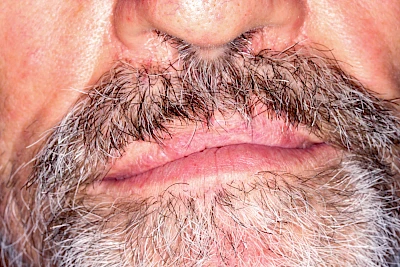 Beispiele: Lippen-Kiefer-Gaumenspalte