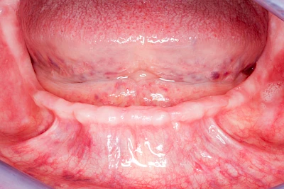 Beispiele: Knochenschwund Unterkiefer