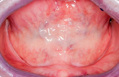 Beispiele: Knochenschwund Unterkiefer