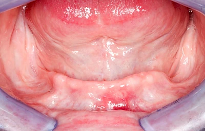 Beispiele: Knochenschwund Unterkiefer