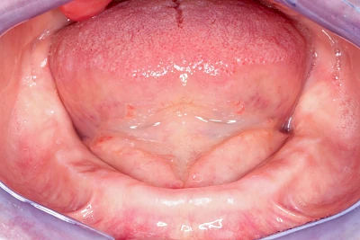 Beispiele: Knochenschwund Unterkiefer