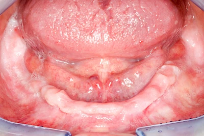 Beispiele: Knochenschwund Unterkiefer