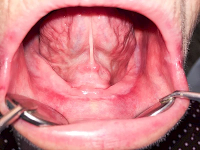 Beispiele: Knochenschwund Unterkiefer