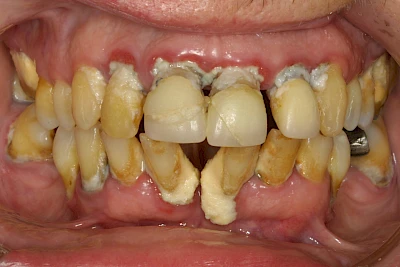 Beispiele: Plaque (Biofilm), Zahnstein & Konkrement