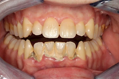 Beispiele: Plaque (Biofilm), Zahnstein & Konkrement