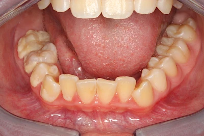 Beispiele: Plaque (Biofilm), Zahnstein & Konkrement