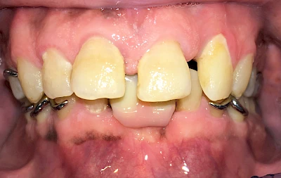 Beispiele: Plaque (Biofilm), Zahnstein & Konkrement