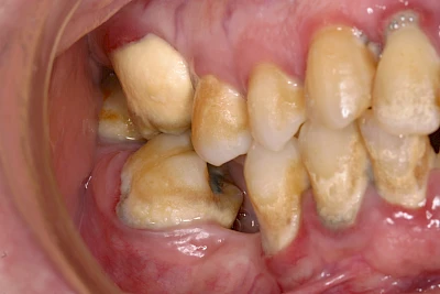 Beispiele: Plaque (Biofilm), Zahnstein & Konkrement