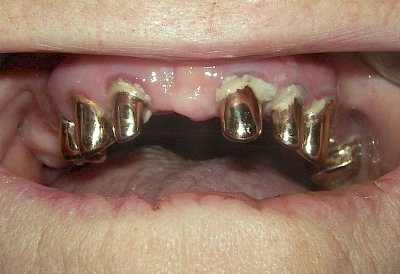 Beispiele: Plaque (Biofilm), Zahnstein & Konkrement