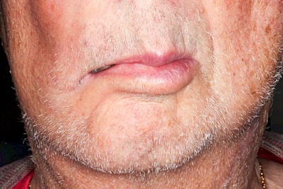 Beispiel: Einbiss-Verletzung bei Zustand nach Schlaganfall