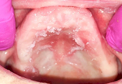 Beispiele: Haftcreme