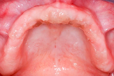 Beispiele: Haftcreme