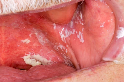 Beispiele: Pilzerkrankung (Soor)