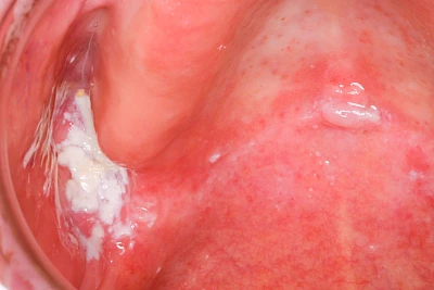 Beispiele: Pilzerkrankung (Soor)