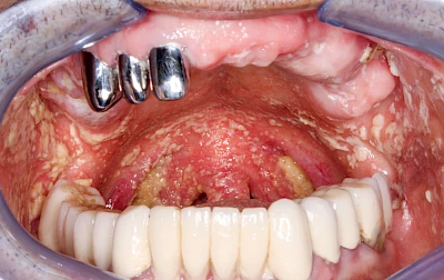 Beispiele: Pilzerkrankung (Soor)