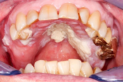 Beispiele: Pilzerkrankung (Soor)