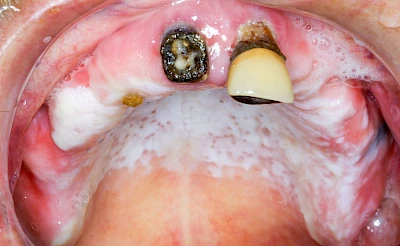 Beispiele: Pilzerkrankung (Soor)