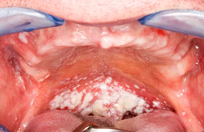 Beispiele: Pilzerkrankung (Soor)