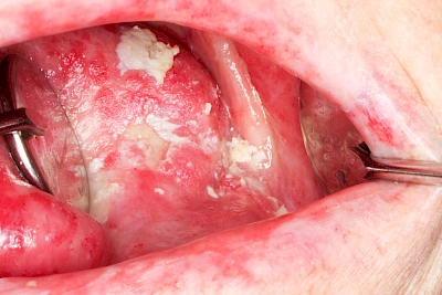 Beispiele: Pilzerkrankung (Soor)