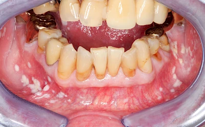 Beispiele: Pilzerkrankung (Soor)
