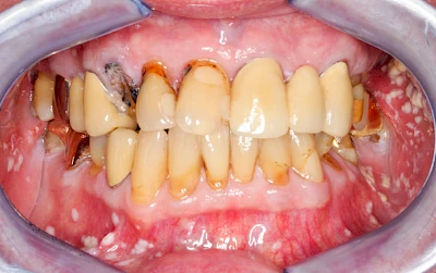 Beispiele: Pilzerkrankung (Soor)