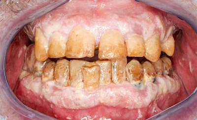 Beispiele: Pilzerkrankung (Soor)