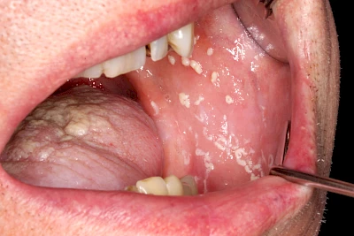 Beispiele: Pilzerkrankung (Soor)