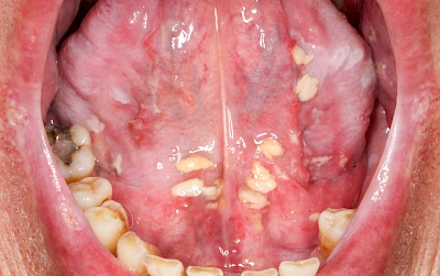Beispiele: Pilzerkrankung (Soor)