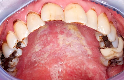 Beispiele: Pilzerkrankung (Soor)