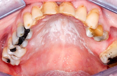 Beispiele: Pilzerkrankung (Soor)