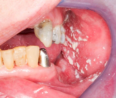 Beispiele: Pilzerkrankung (Soor)