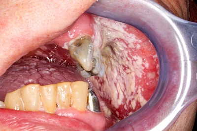 Beispiele: Pilzerkrankung (Soor)