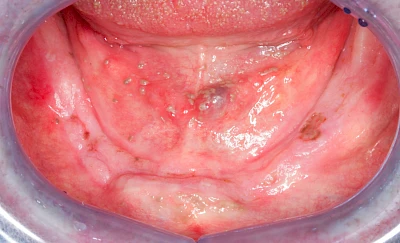 Beispiele: Pilzerkrankung (Soor)