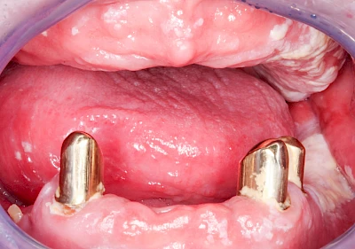 Beispiele: Pilzerkrankung (Soor)