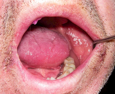 Beispiele: Pilzerkrankung (Soor)