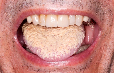 Beispiele: Belegte Zunge