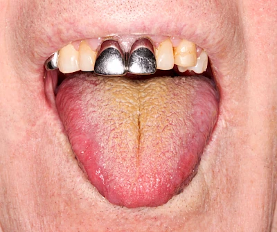 Beispiele: Belegte Zunge