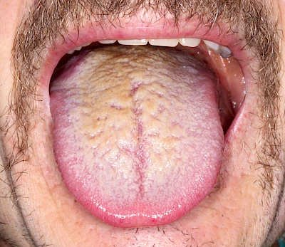 Beispiele: Belegte Zunge