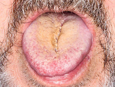 Beispiele: Belegte Zunge