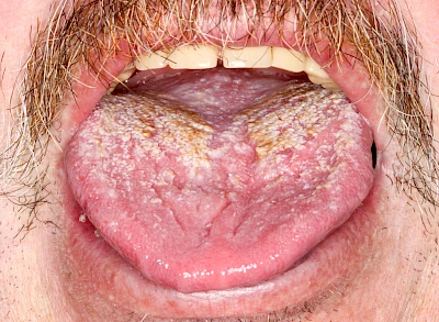 Beispiele: Belegte Zunge