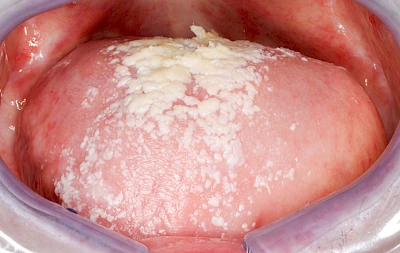 Beispiele: Belegte Zunge