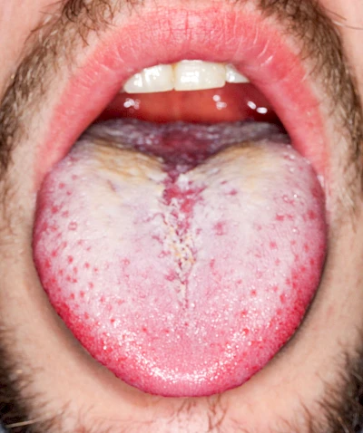 Beispiele: Belegte Zunge