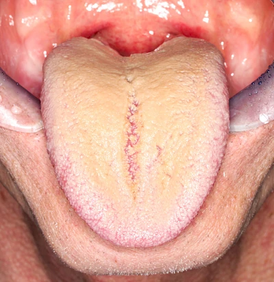 Beispiele: Belegte Zunge