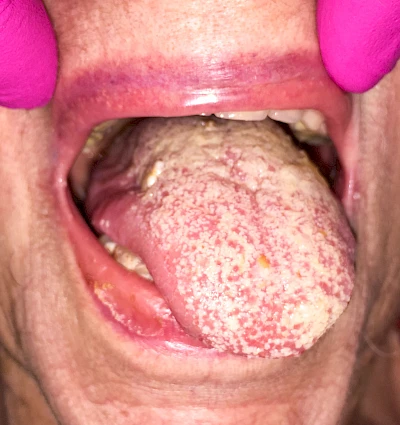 Beispiele: Belegte Zunge