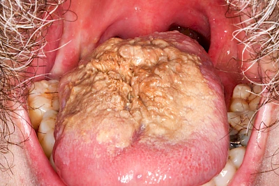 Beispiele: Belegte Zunge